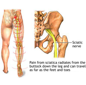 sciatica-pain